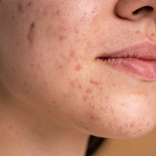 Acne-prone