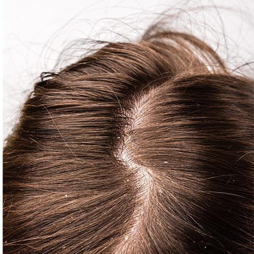 Dandruff