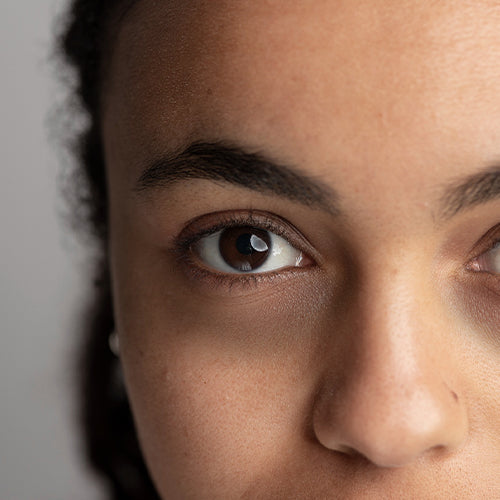 Dark Circles & Puffiness