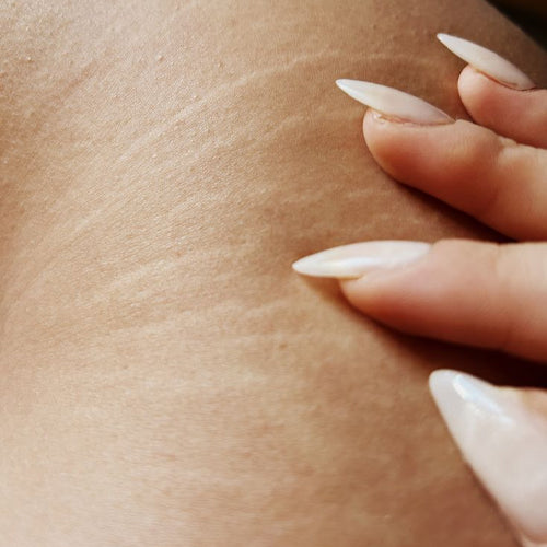 Stretch Marks
