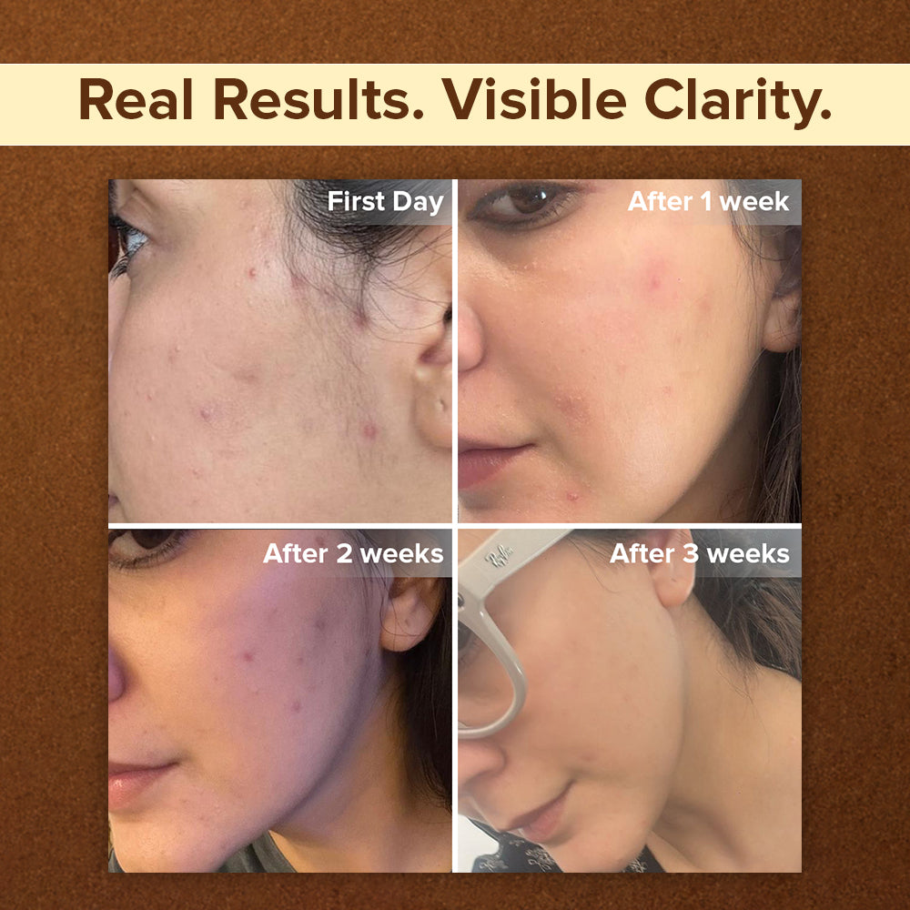 Neem and Haldi Anti-Acne Face Wash