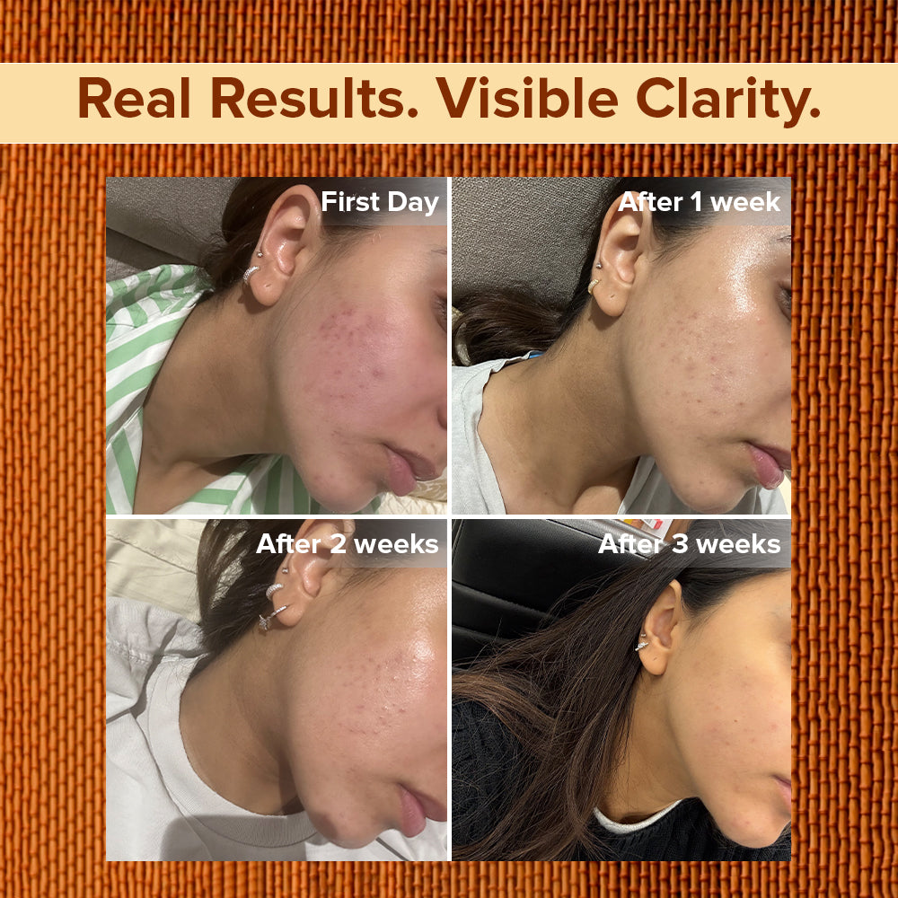 Cucumber & Turmeric Anti-Acne Skin Repair Face Gel